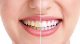 035247800_1457337377-052052600_1414213218-yellow-teeth.jpg